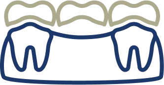 Dental Bridges